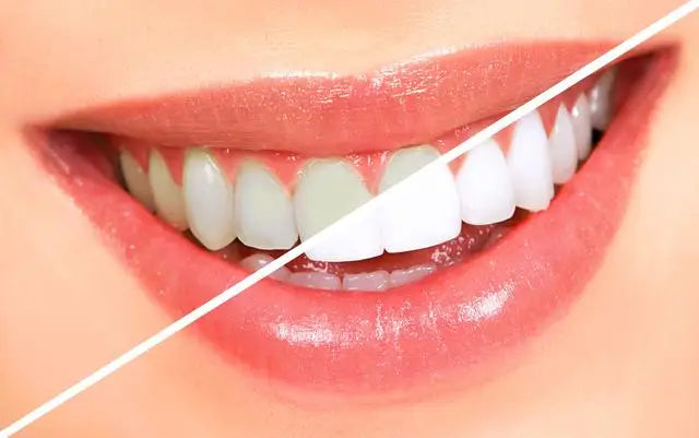 LED Teeth Whitening Light